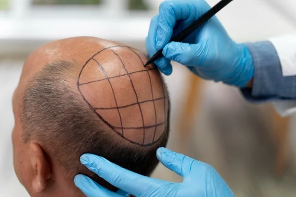 Hair Restoration & Hair Transplant