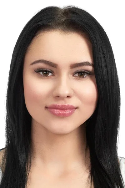 Buccal Fat Excision after result