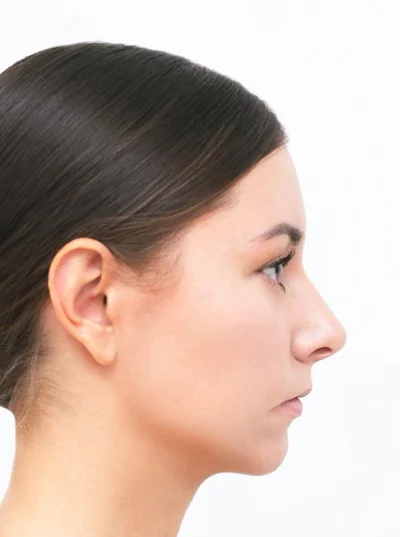 Chin Augmentation after result