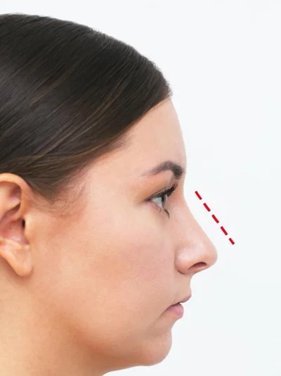 Ethnic Rhinoplasty after result