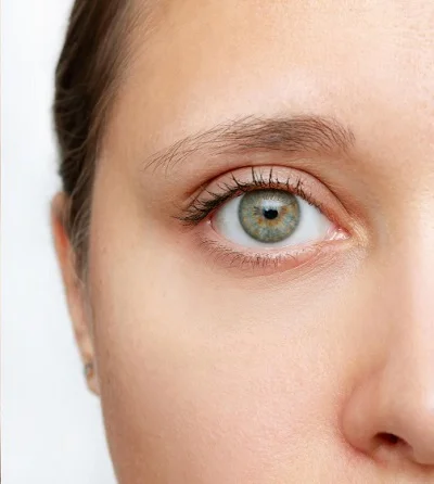 Eyelid Surgery after result