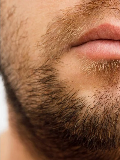 Facial Hair Restoration after result