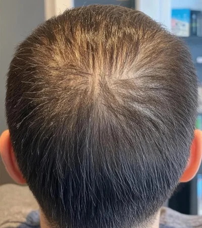 Methods of Hair Restoration after result