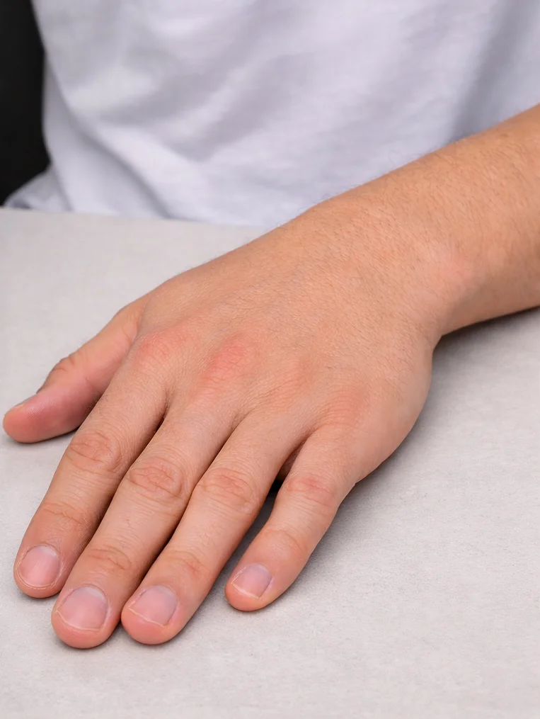 Laser Hair Removal For Men after result