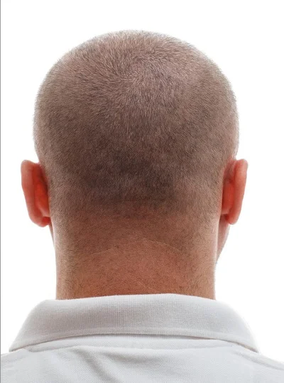 Male Hair Transplant after result