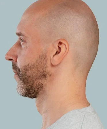 Male Rhinoplasty after result