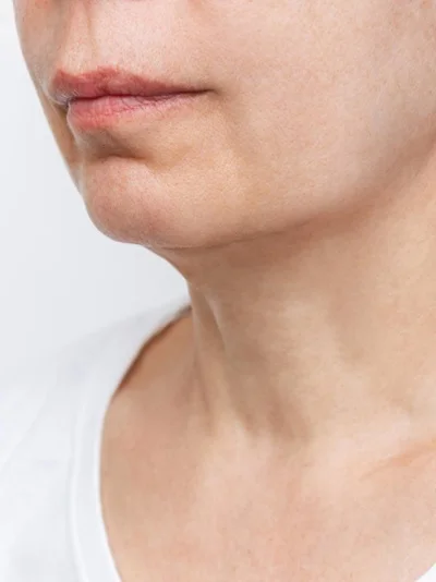 Neck Lift after result