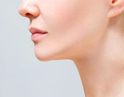 Neck Liposuction after result