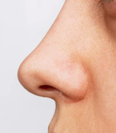 Non Surgical Rhinoplasty Result after result