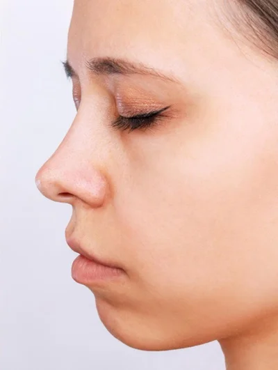Rhinoplasty (Nose Surgery) after result