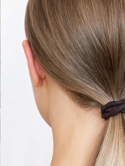 Otoplasty & Earlobe Repair after result