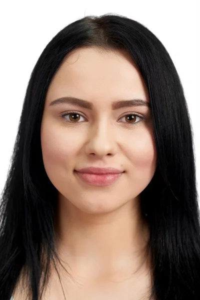 Buccal Fat Excision before result