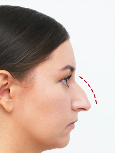 Ethnic Rhinoplasty before result