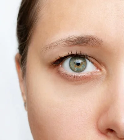 Eyelid Surgery before result