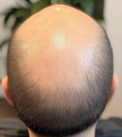 Methods of Hair Restoration before result