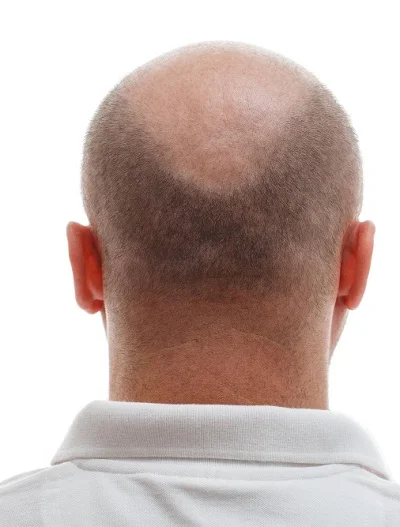 Male Hair Transplant before result