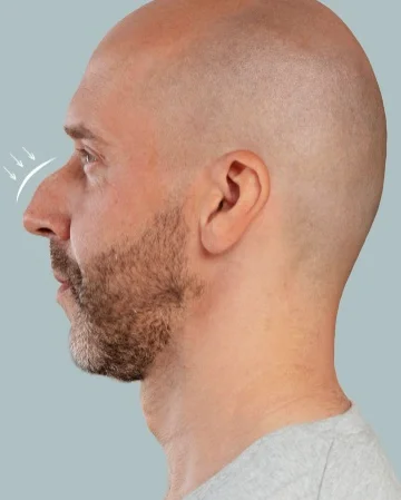 Male Rhinoplasty before result