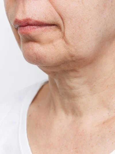Neck Lift before result