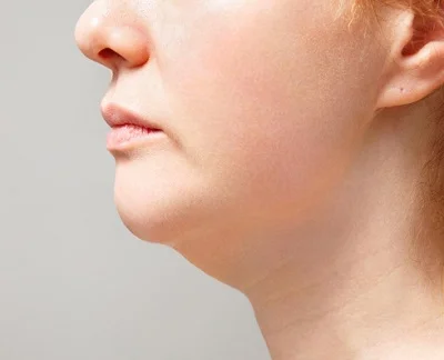 Neck Liposuction before result