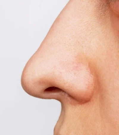 Non Surgical Rhinoplasty Result before result