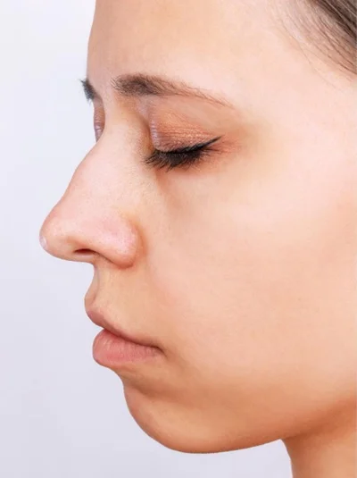 Rhinoplasty (Nose Surgery) before result
