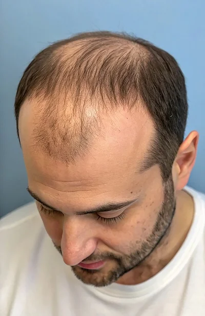 PRP Hair Loss Treatment before result