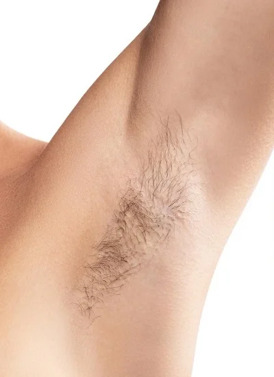 Underarm Laser Hair Removal before result