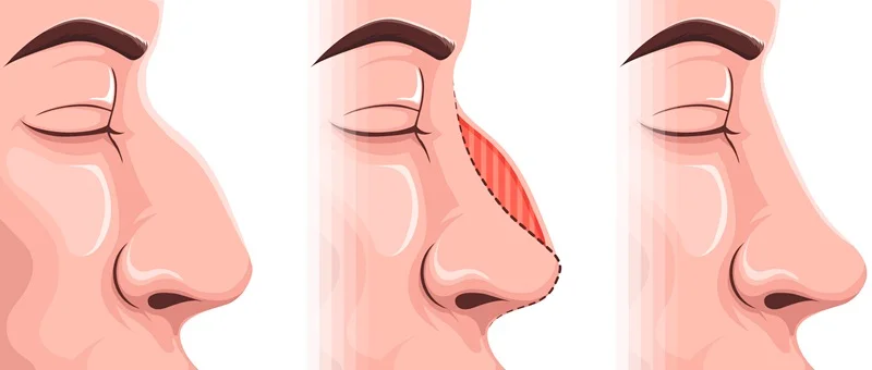 About Rhinoplasty